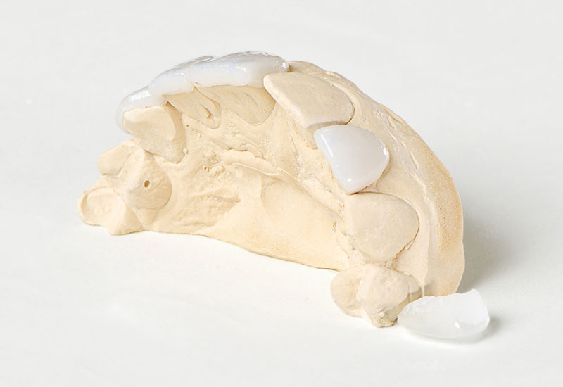 Modell von Zahnveneers