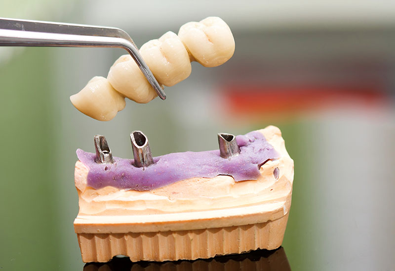 Großaufnahme einer Zahnbrücke am Modell.